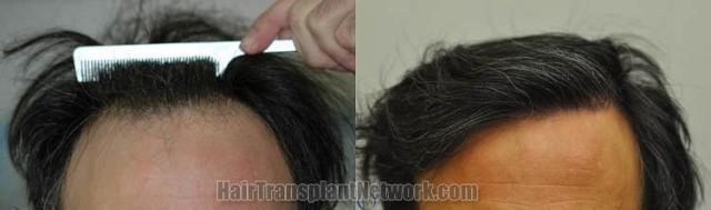 Before and after hair transplant procedure images