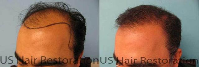 Hair restoration procedure before and after results