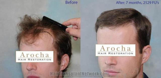 Surgical hair transplantation result photographs