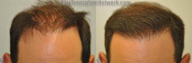 Hair transplantation surgery before and after photos