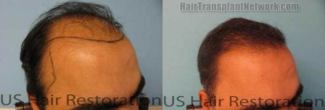 Before and after hair transplant procedure images