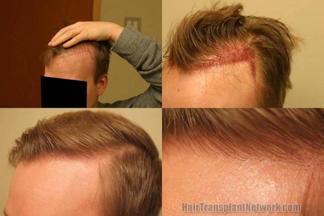 Hair transplantation surgery before and after pictures