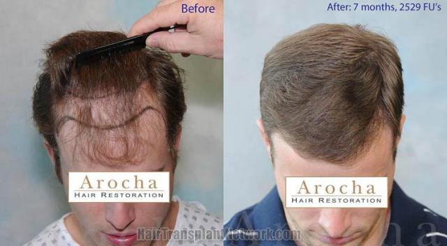 Top view before and after hair restoration results