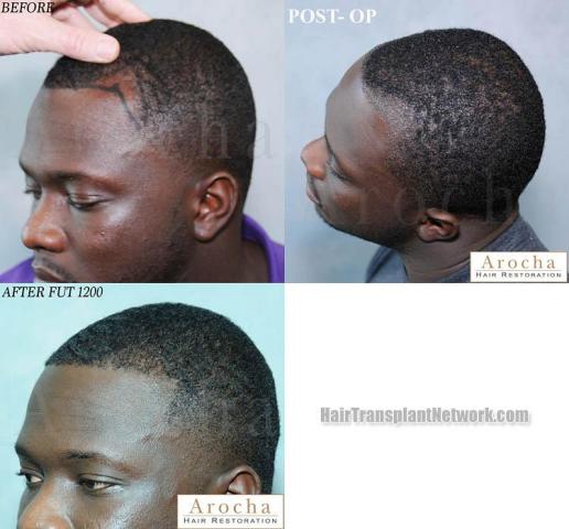 Hair transplantation surgery before and after images