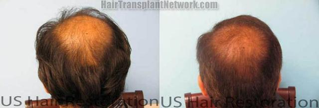 Back view before and after hair transplantation photos