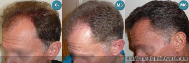 Left view before and after hair transplant images