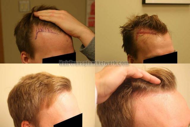 Hair transplantation surgery before and after images