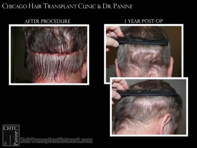 Surgical hair transplantation result photographs