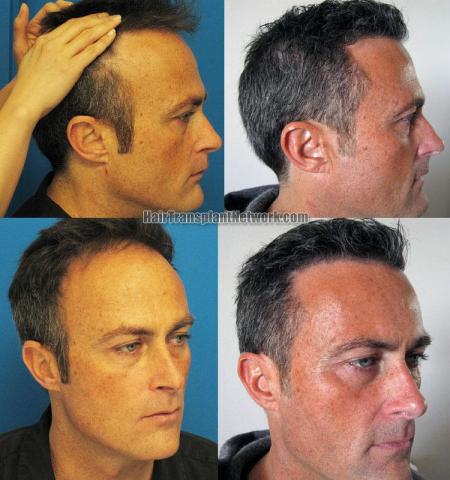 Hair transplantation surgery before and after pictures