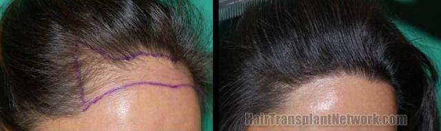 Hair transplant procedure before and after images