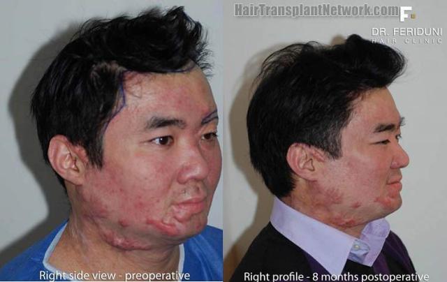  procedure before and after photos