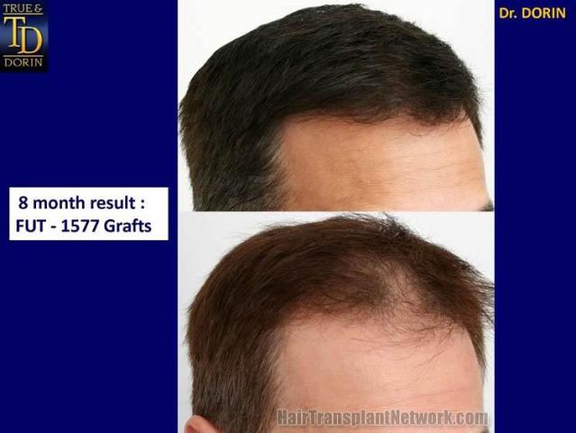 Hair replacement surgery before and after photographs