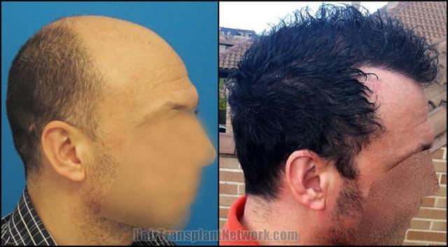 Hair transplantation surgery before and after images