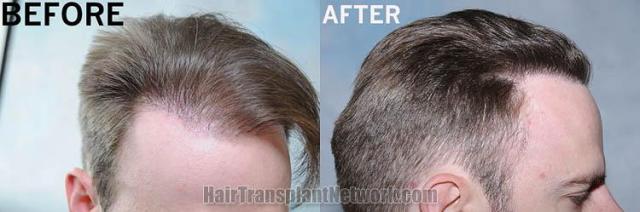 Hair transplantation surgery before and after photos