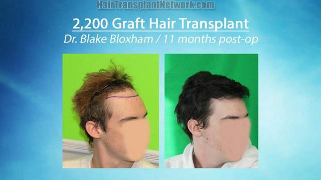 Hair transplantation procedure before and after results
