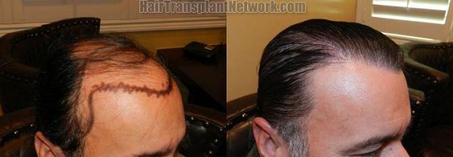 Dr John Diep Hair Transplant Procedure Before And After Result Images