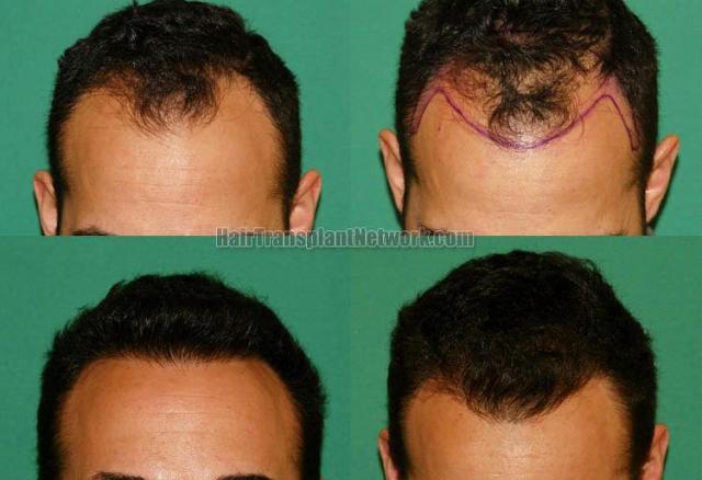Front View - Before and after hair transplantation surgery