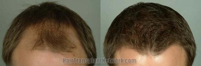 Tilt view before and after hair restoration results
