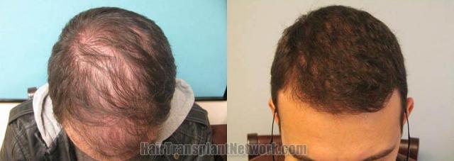 Top view before and after hair restoration results