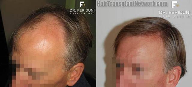 Surgical hair transplantation result photographs