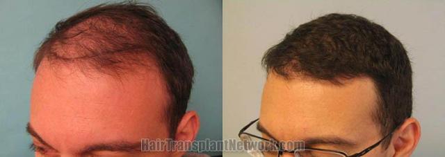 urgical hair transplantation result photographs