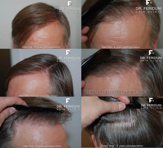 Hair replacement surgery before and after images