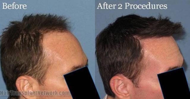 Photos showing before and after hair restoration results