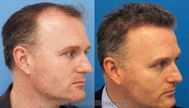 Hair restoration procedure before and after results