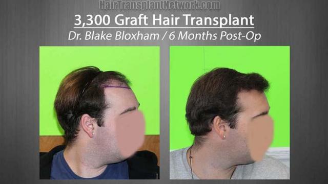 Hair restoration procedure before and after results photographs