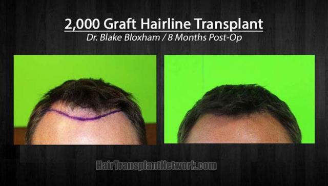 Hair restoration procedure before and after photographs
