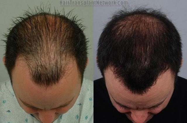 Top view before and after hair replacement procedure