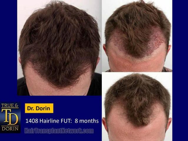 Top view before and after hair restoration results