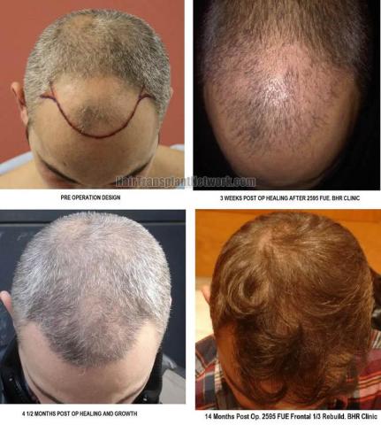 Hair transplantation surgery before and after photos