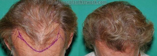 Hair restoration procedure before and after results