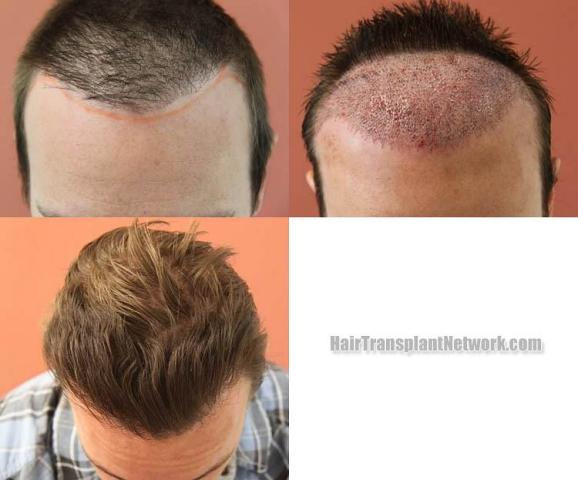 Hair transplantation surgery before and after photos