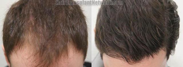 Hair transplantation surgery before and after photos