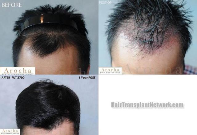 Hair transplantation surgery before and after photos