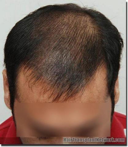 Hair restoration procedure results