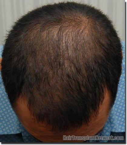 Hair restoration procedure results