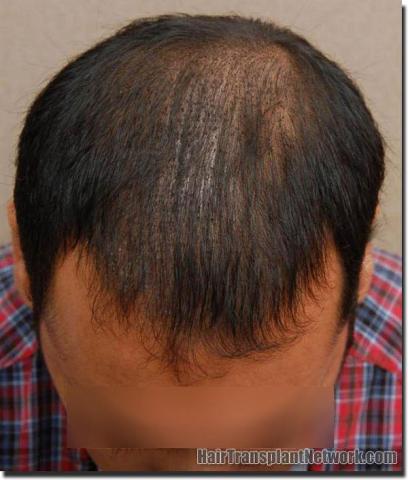 Hair restoration procedure results