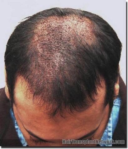 Hair restoration procedure results