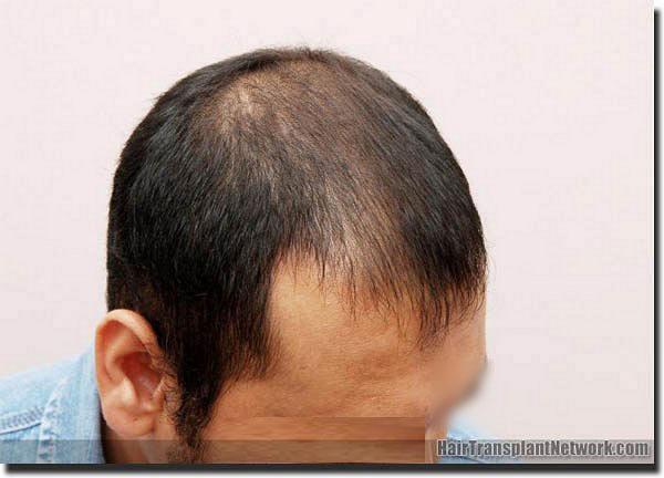 Hair restoration procedure results