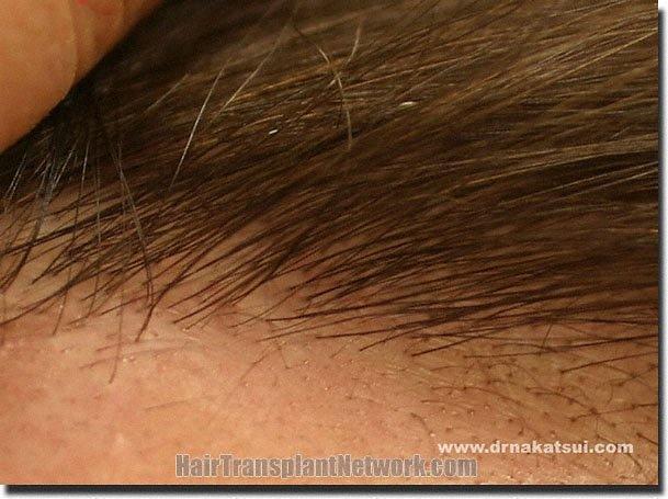 Hair restoration procedure results