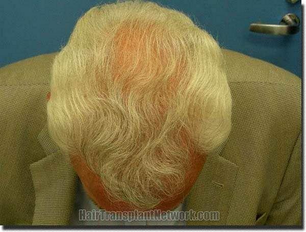 Hair restoration procedure results