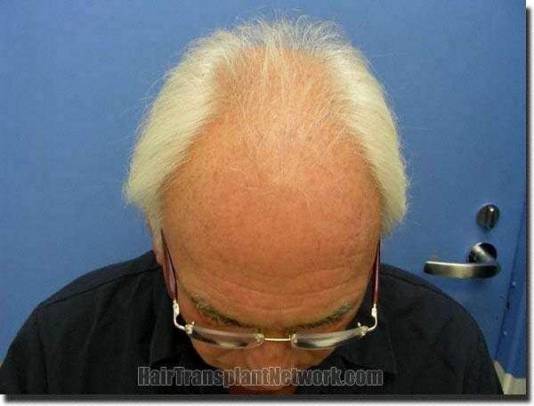 Hair restoration procedure results