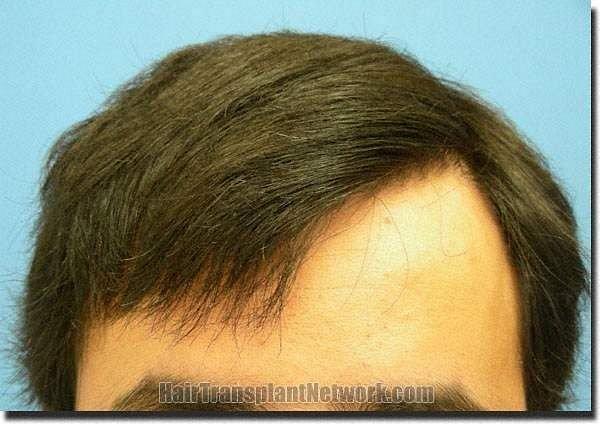 Hair restoration procedure results