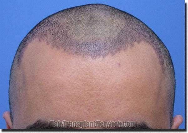 Hair restoration procedure results