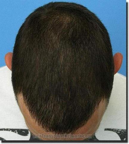 Hair restoration procedure results