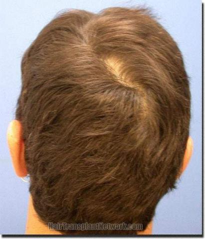 Hair restoration procedure results