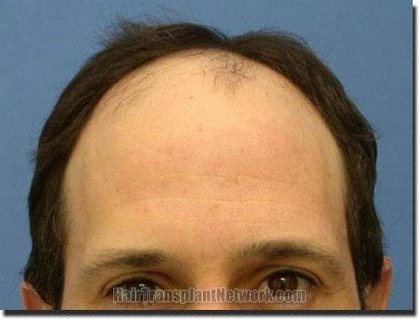 Hair restoration procedure results